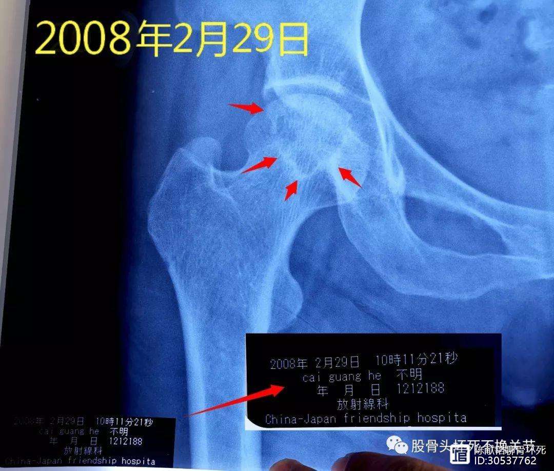 重庆人工骨头医保报销多少(人工骨头医保报销多少比例)