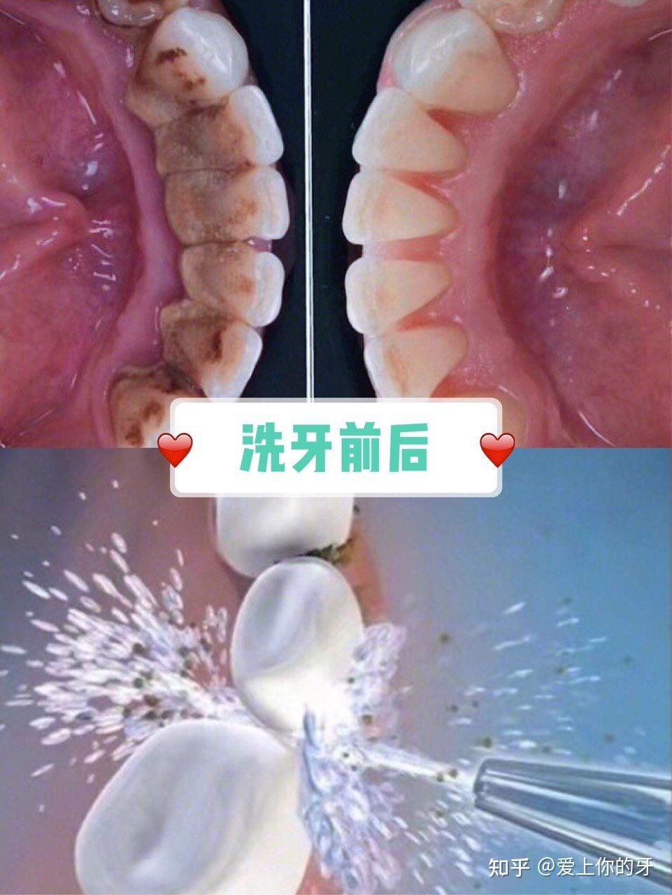 重庆洗牙可以用医保吗(洗牙可以用医保吗,报销比例多少)